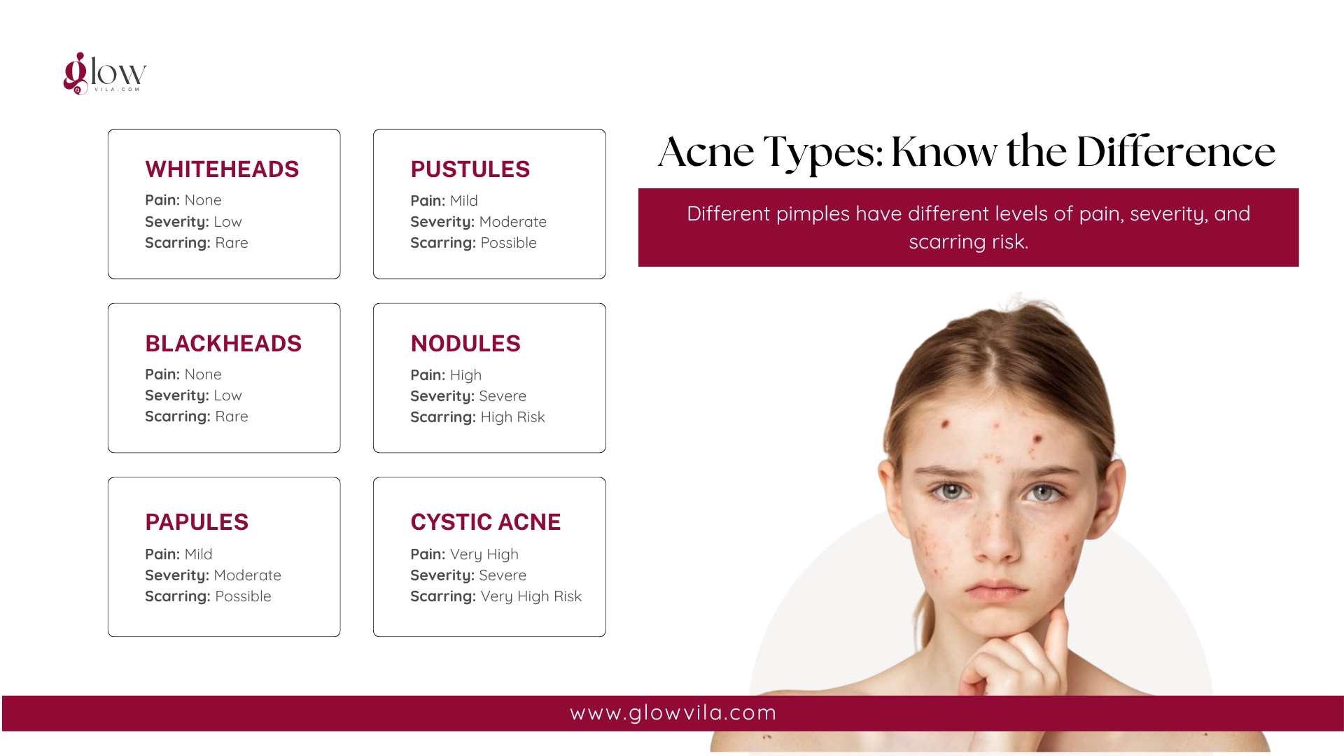 Infographic comparing pain, severity, and scarring risk of whiteheads, blackheads, papules, pustules, nodules, and cystic acne