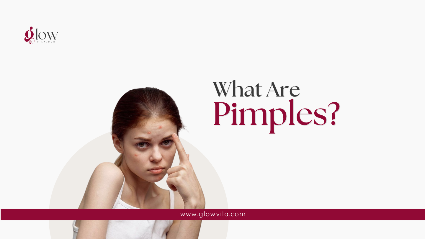 Woman pointing to a pimple on her forehead illustrating what a pimple is