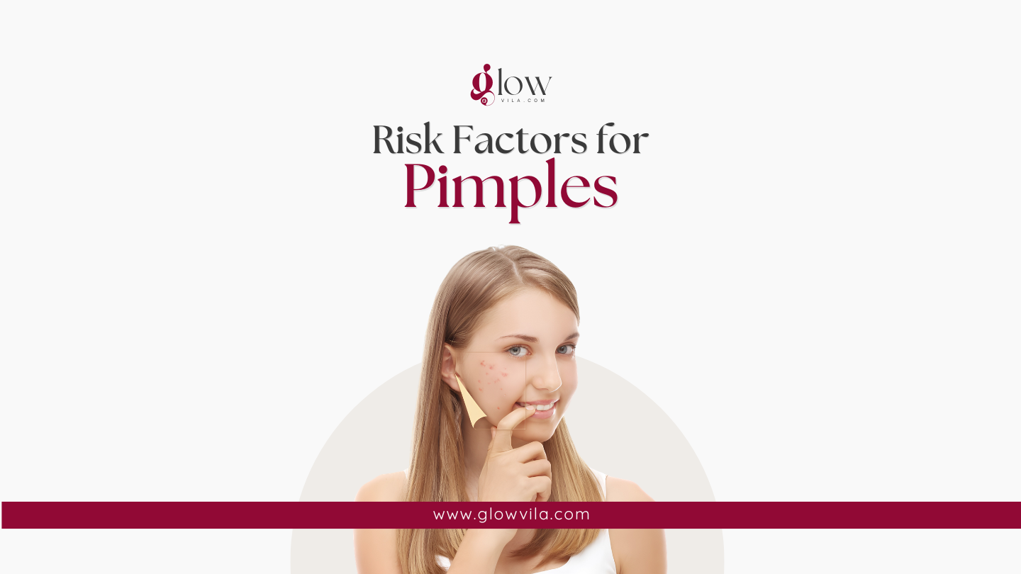 Woman with visible cheek pimples representing risk factors for acne breakouts