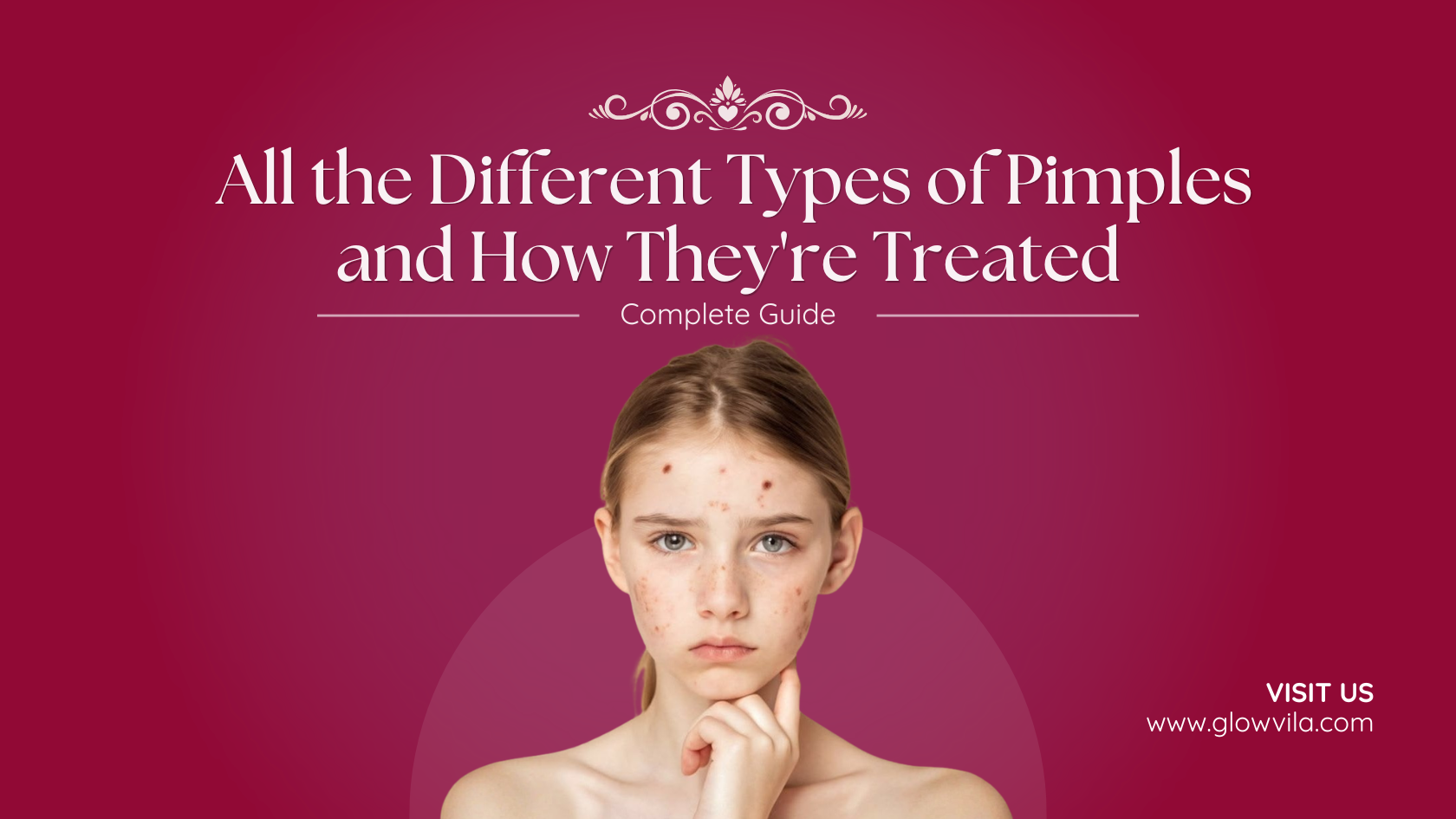 Teenage girl with visible facial acne, complete guide to different types of pimples and treatment