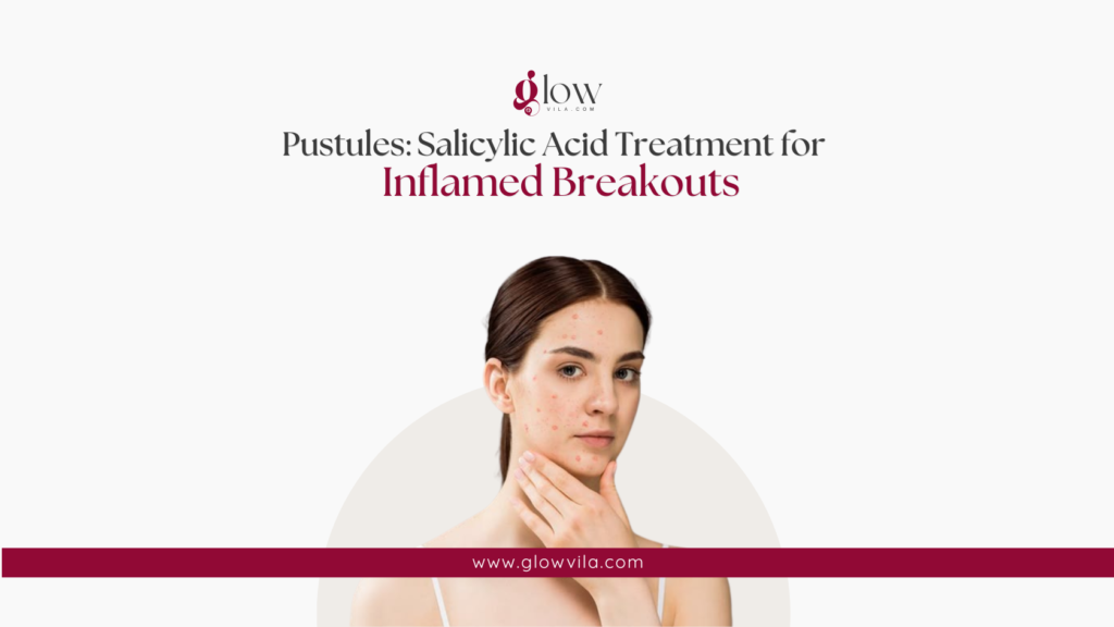Woman with inflamed pustules on her cheek, salicylic acid treatment for inflamed breakouts