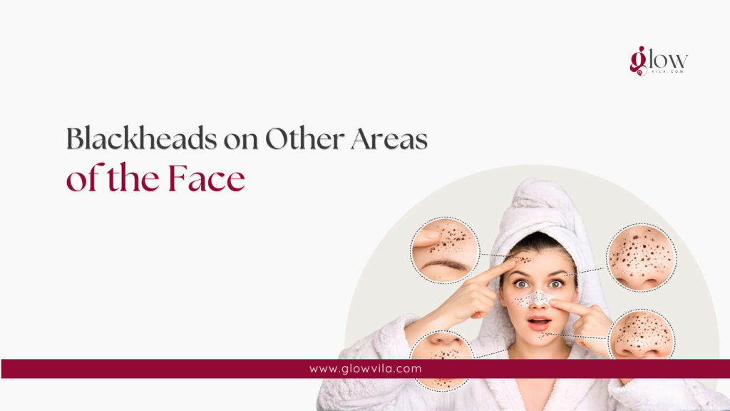 Close-up images showing blackheads on the forehead, chin, and nose areas of the face
