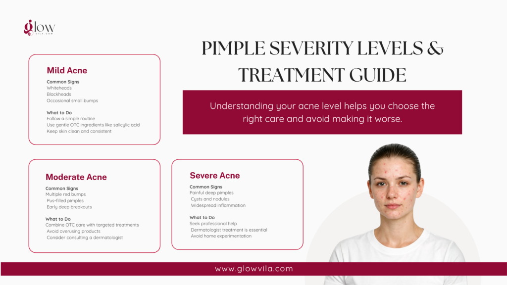 Infographic comparing mild, moderate, and severe acne with common signs and recommended treatment for each level