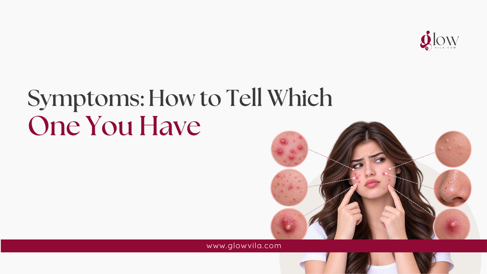Woman pointing to breakouts on her face surrounded by close-up images of pimples and acne symptoms