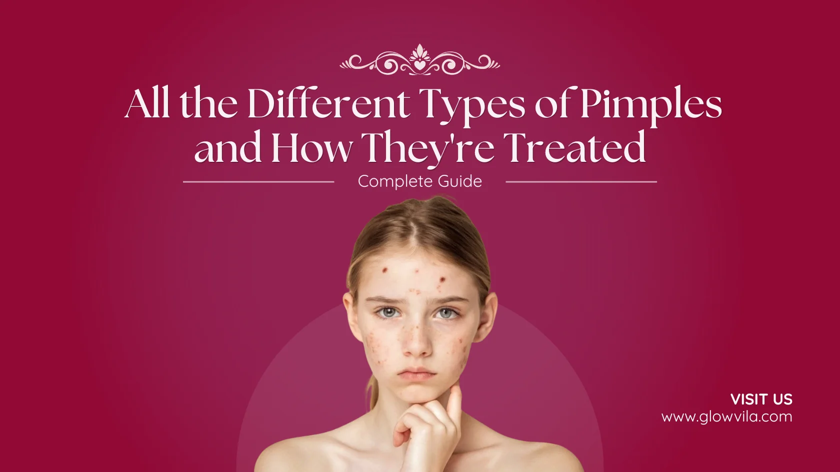 Teenage girl with visible facial acne, complete guide to different types of pimples and treatment