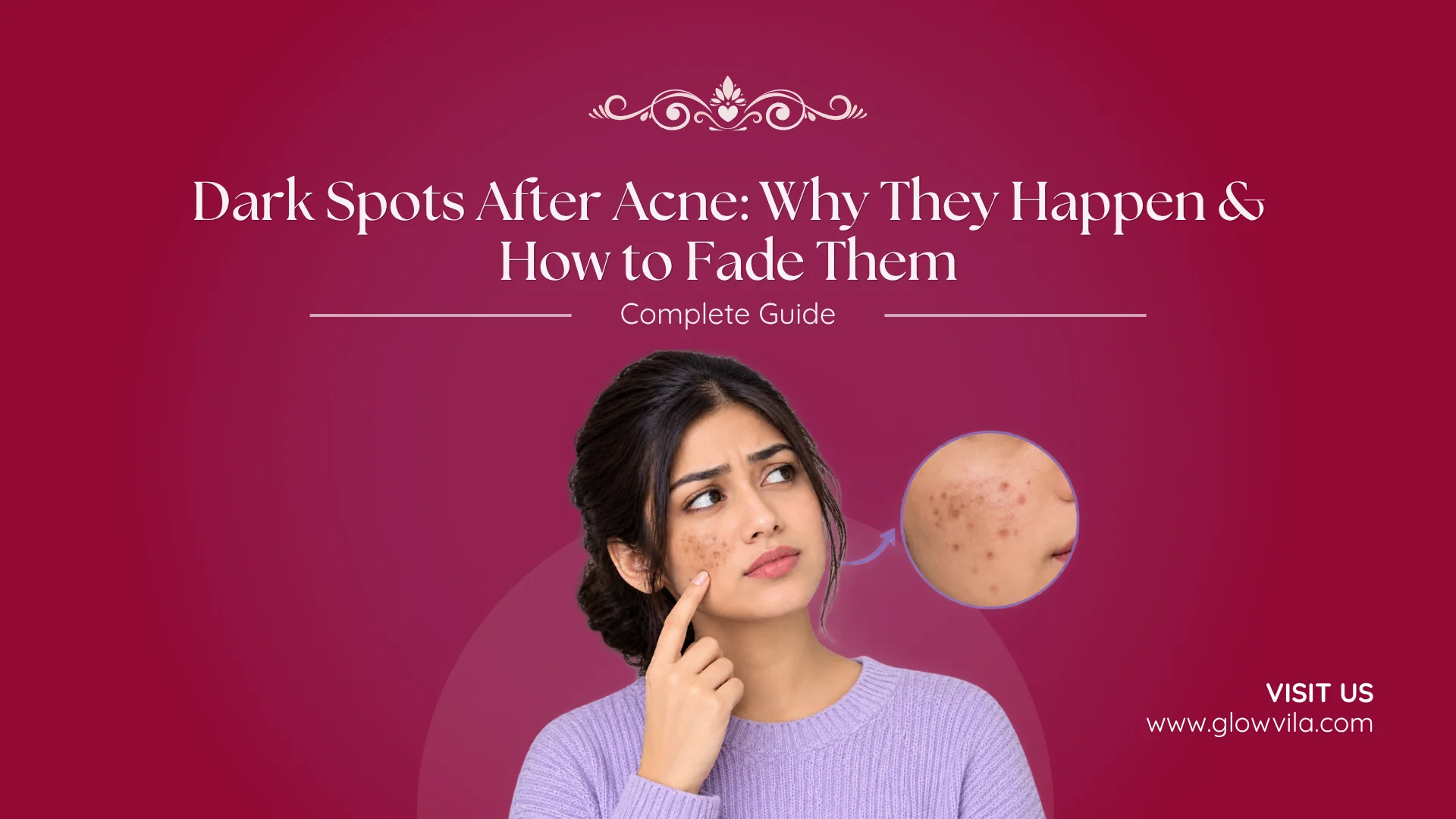 dark spots after acne